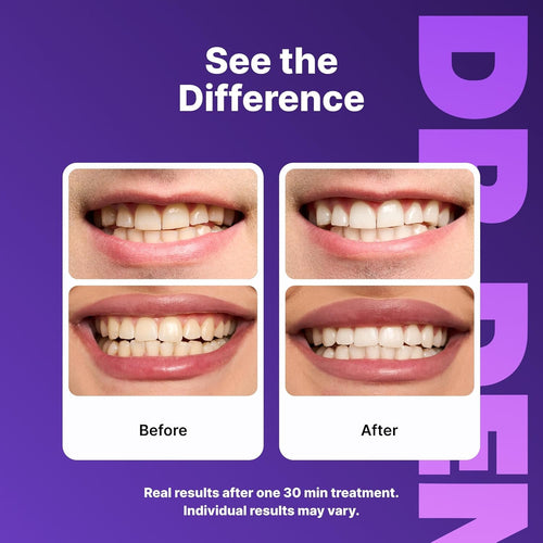 Sparkle Smile Whitening Strips